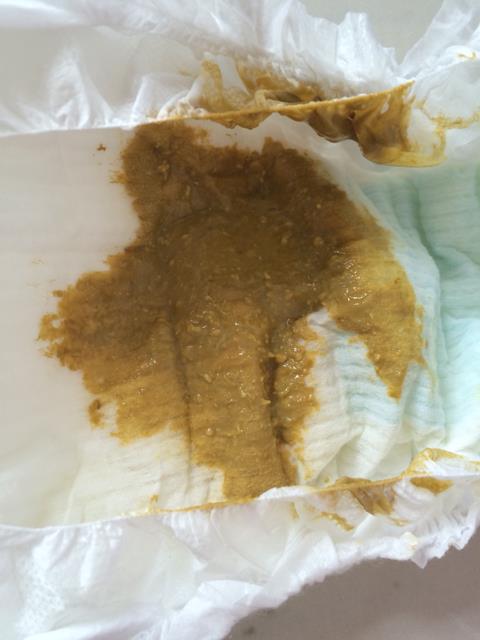 强直性脊柱炎大便长期不成形