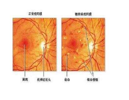 糖尿病视网膜病变