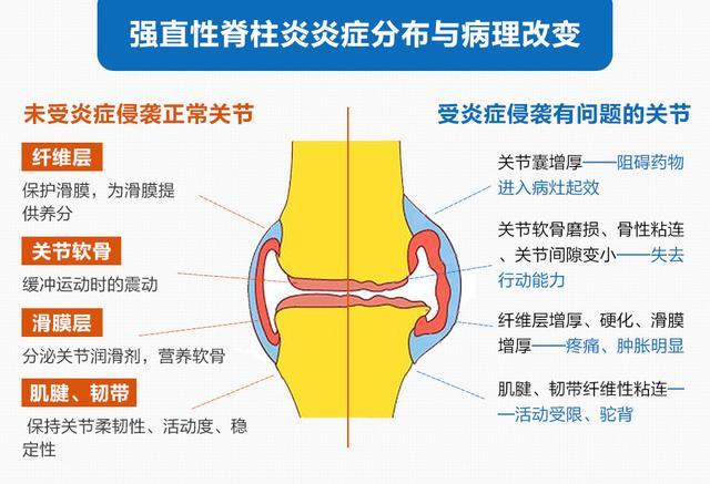 强直性脊柱炎柳氮磺