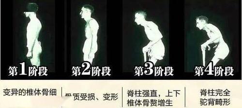 强直性脊柱炎体验分娩