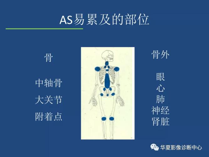 强直性脊柱炎影响艾滋检查吗