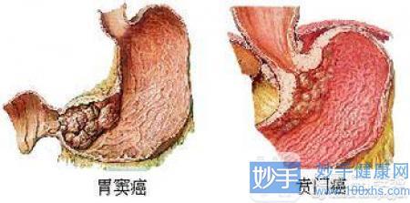 胃癌