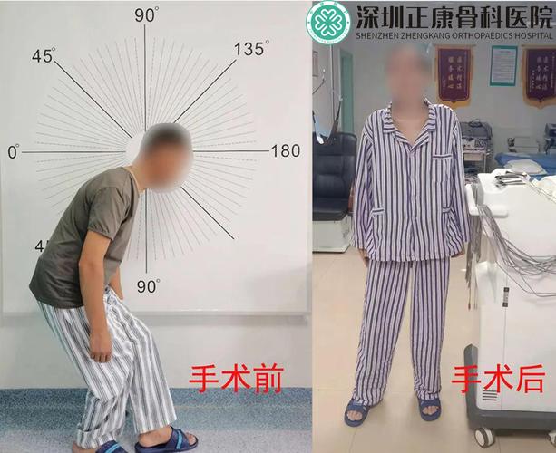 强直性脊柱炎骨髓穿刺