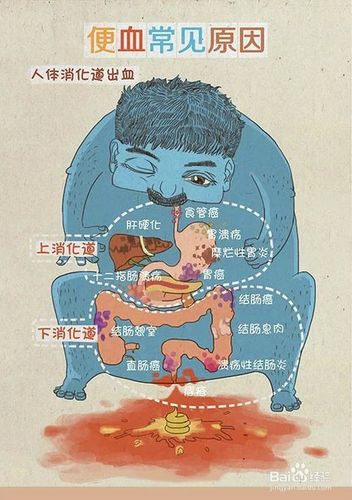 溃疡性结肠炎排便和水一样