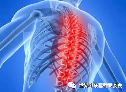 强直性脊柱炎止痛