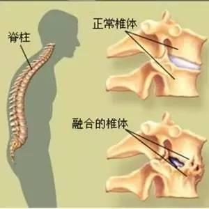 强直性脊柱炎患者腰间盘突出