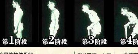 周杰伦强直性脊柱炎吃止痛药浮肿