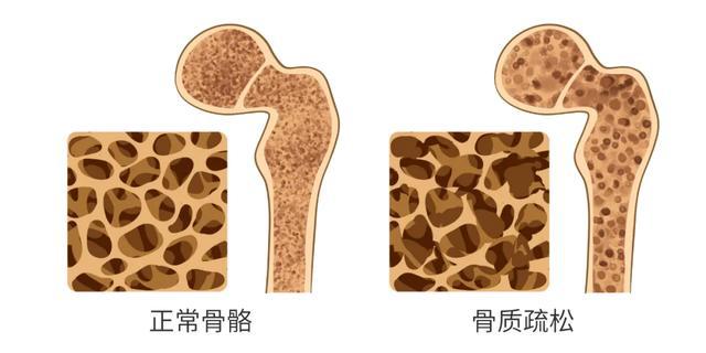 陕西强直性脊柱炎属于慢病医保吗