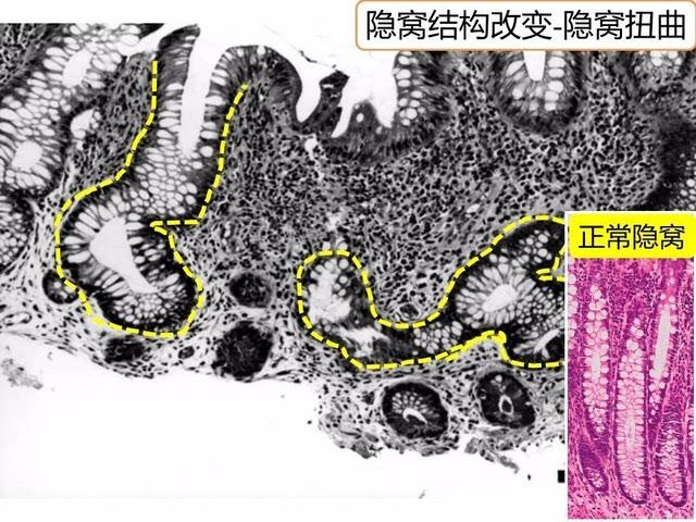 溃疡性结肠炎病因