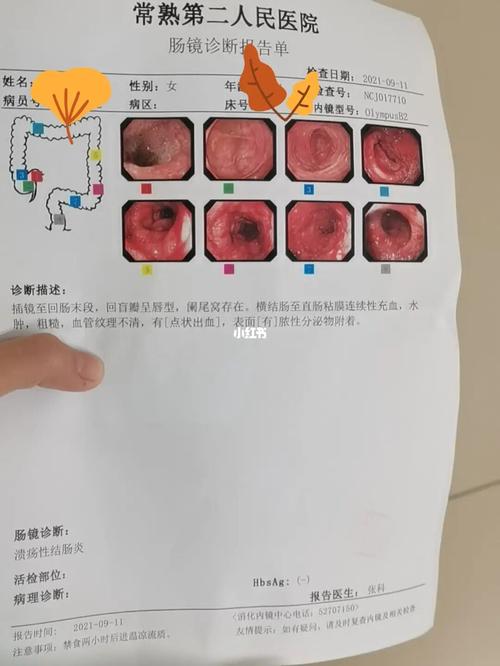 溃疡性结肠炎可以吃鸡头