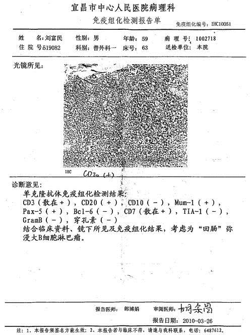 小淋巴细胞淋巴瘤