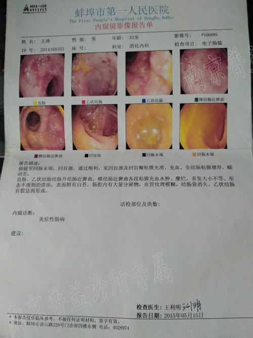 溃疡性的结肠炎好治吗
