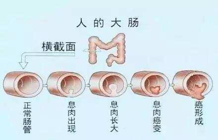 长息肉和溃疡性结肠炎有关系吗