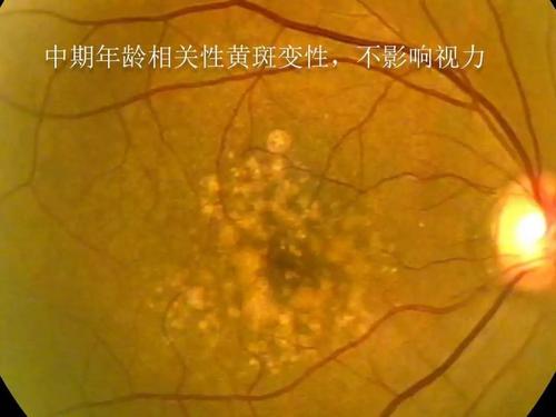湿性黄斑变性