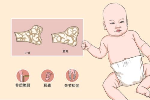成骨不全症
