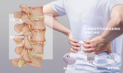 强直性脊柱炎能引起关节病变吗