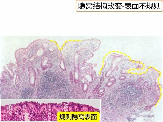 溃疡性结肠炎一直低烧