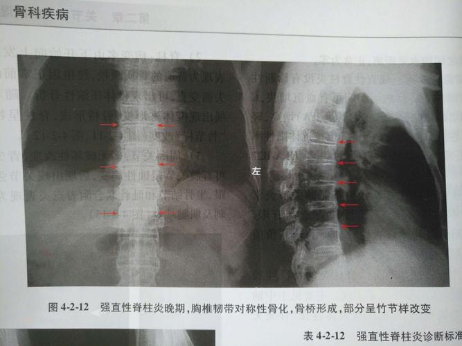强直性脊柱炎用什么检测