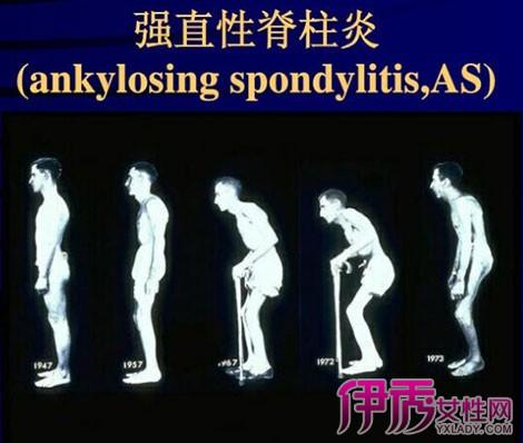 强直性脊柱炎锻炼女版