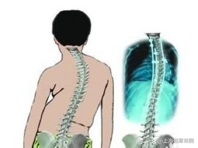 得了强直性脊柱炎暴瘦几十斤