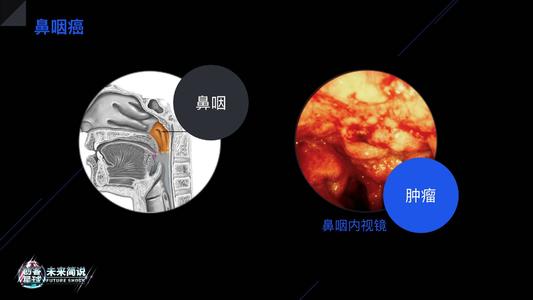 鼻咽癌