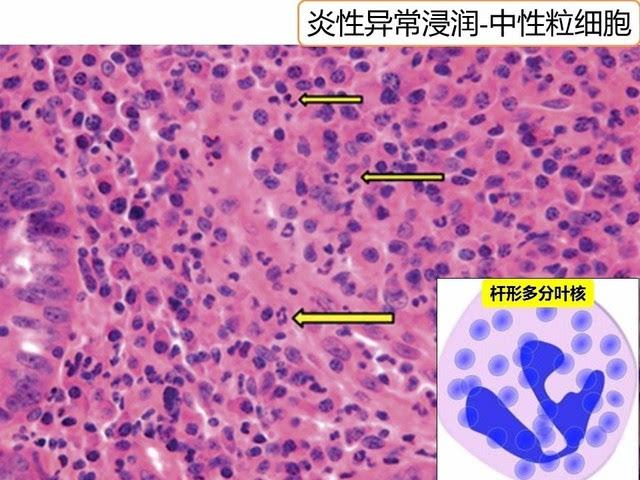 溃疡性结肠炎大便上全是粘液