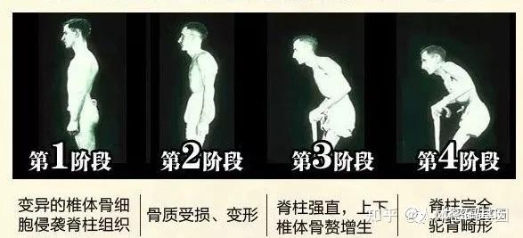 强直性脊柱炎拍片能查吗
