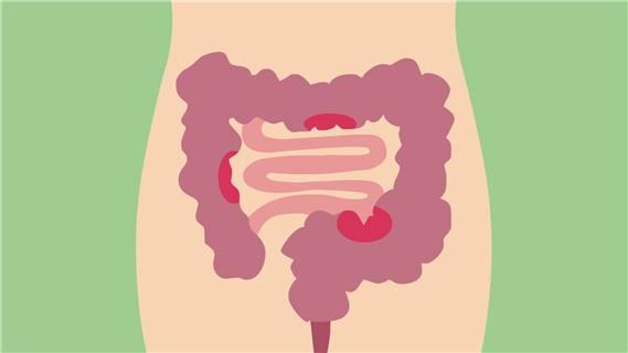 溃疡性结肠炎会引起右侧腰腿疼吗