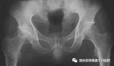 强直性脊柱炎怎么检测