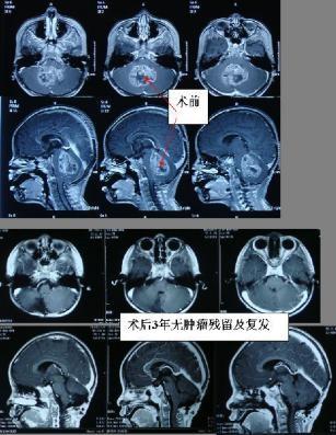 脑胶质瘤