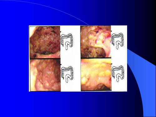看溃疡性结肠炎厉害的专家