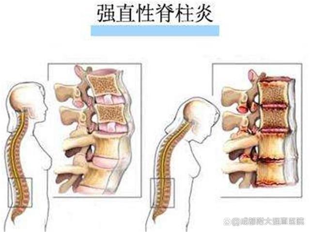 强直性脊柱炎吃柳氮为什么会腹泻