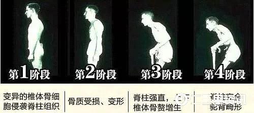 强直性脊柱炎打三针疫苗