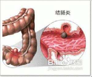 我有溃疡性结肠炎能变成癌症吗