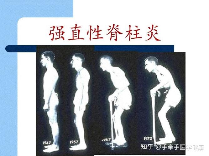 强直性脊柱炎发病期