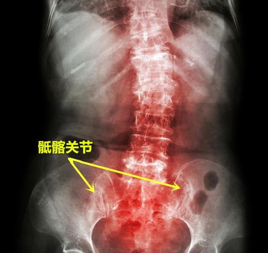 腰椎核磁结果会显示强直性脊柱炎