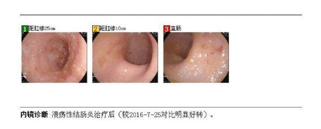 溃疡性结肠炎生物制剂类克靠谱吗