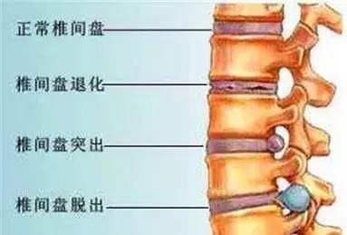 背疼痛诊断出强直性脊柱炎