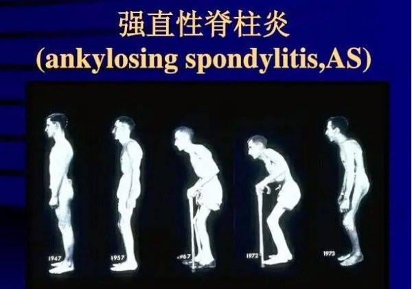 感觉肌肉无力是强直性脊柱炎