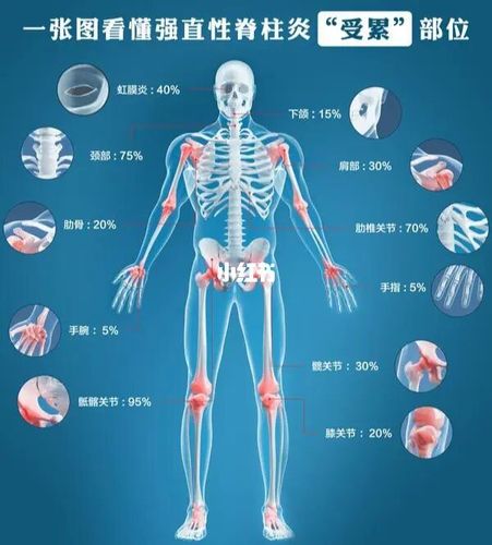 只腰背疼会是强直性脊柱炎吗