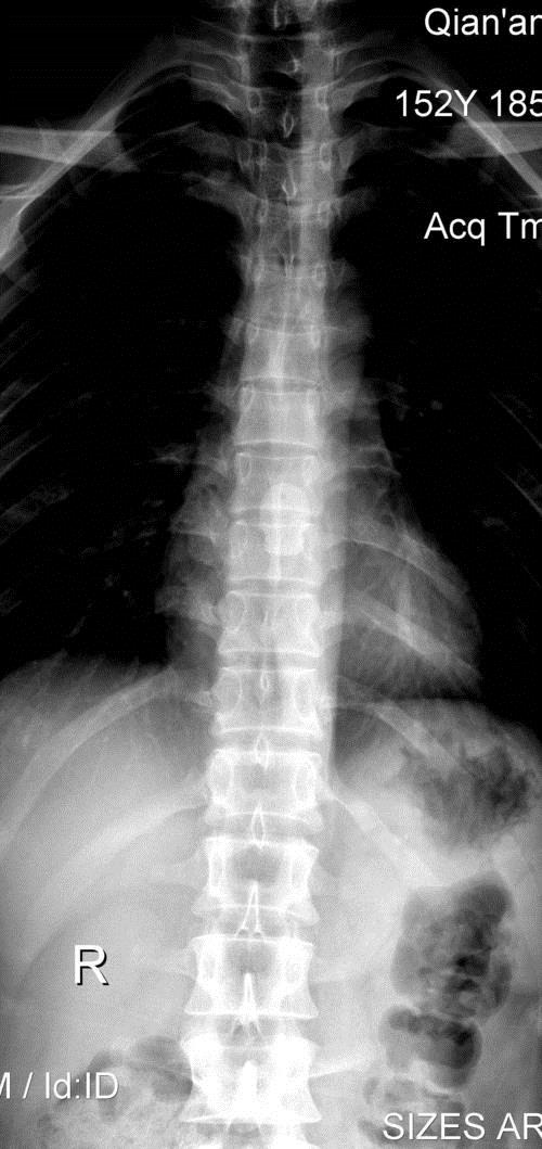 强直性脊柱炎为什么会瘫痪