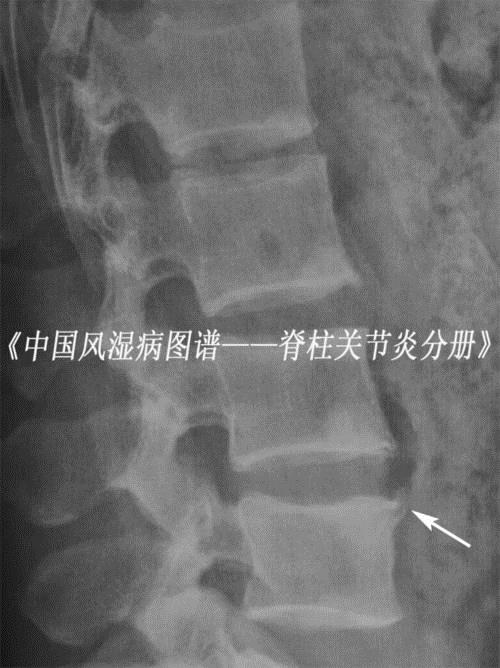 强直性脊柱炎椎体拍片是方椎吗