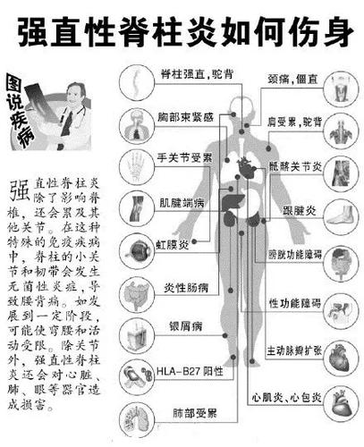 血栓跟强直性脊柱炎怎么区别