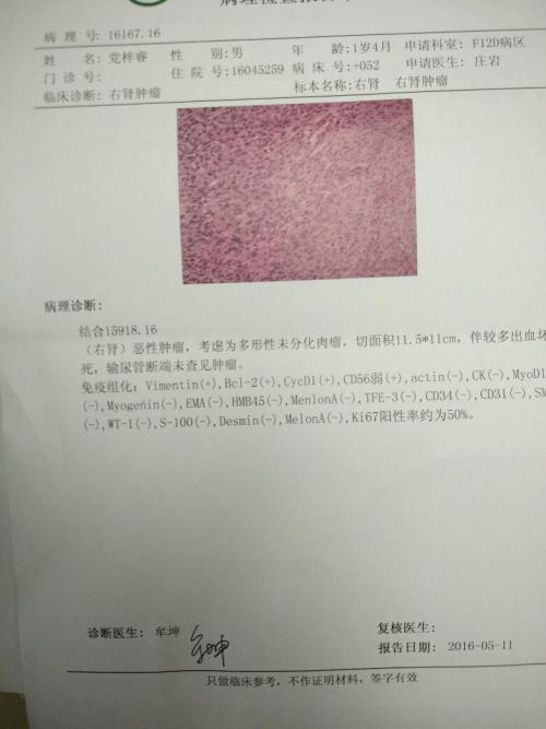 肾母细胞瘤
