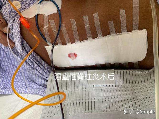 强直性脊柱炎净骨疗法