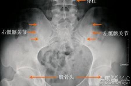 男性强直性脊柱炎55岁能退休吗