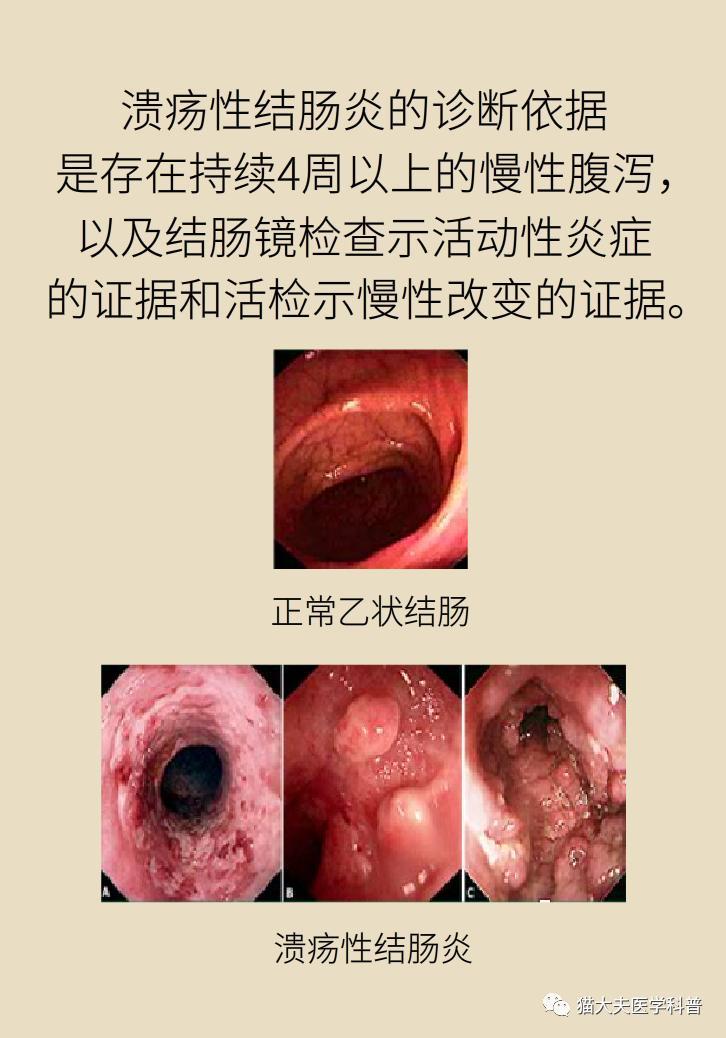 溃疡性结肠炎50年了
