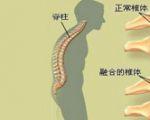 强直性脊柱炎晚期影响怀孕吗