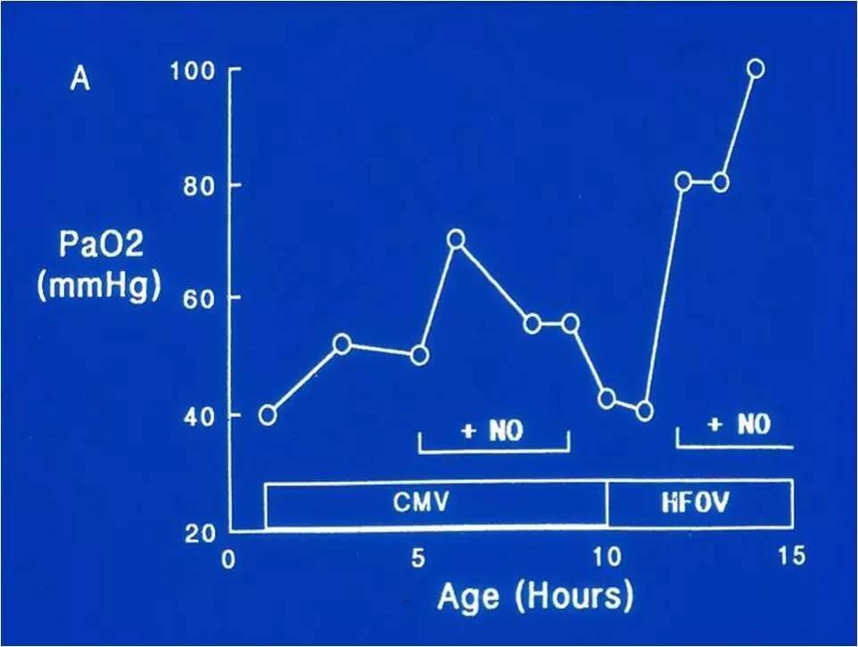何少茹:胎粪吸入综合征发病机制和治疗现状