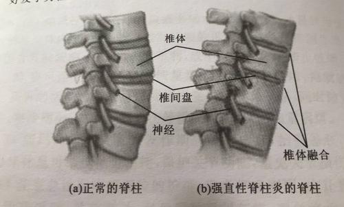 强直性脊柱炎负重跑会怎样
